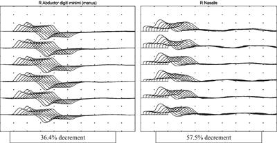 Polymyxin-induced neuromuscular weakness: a case report